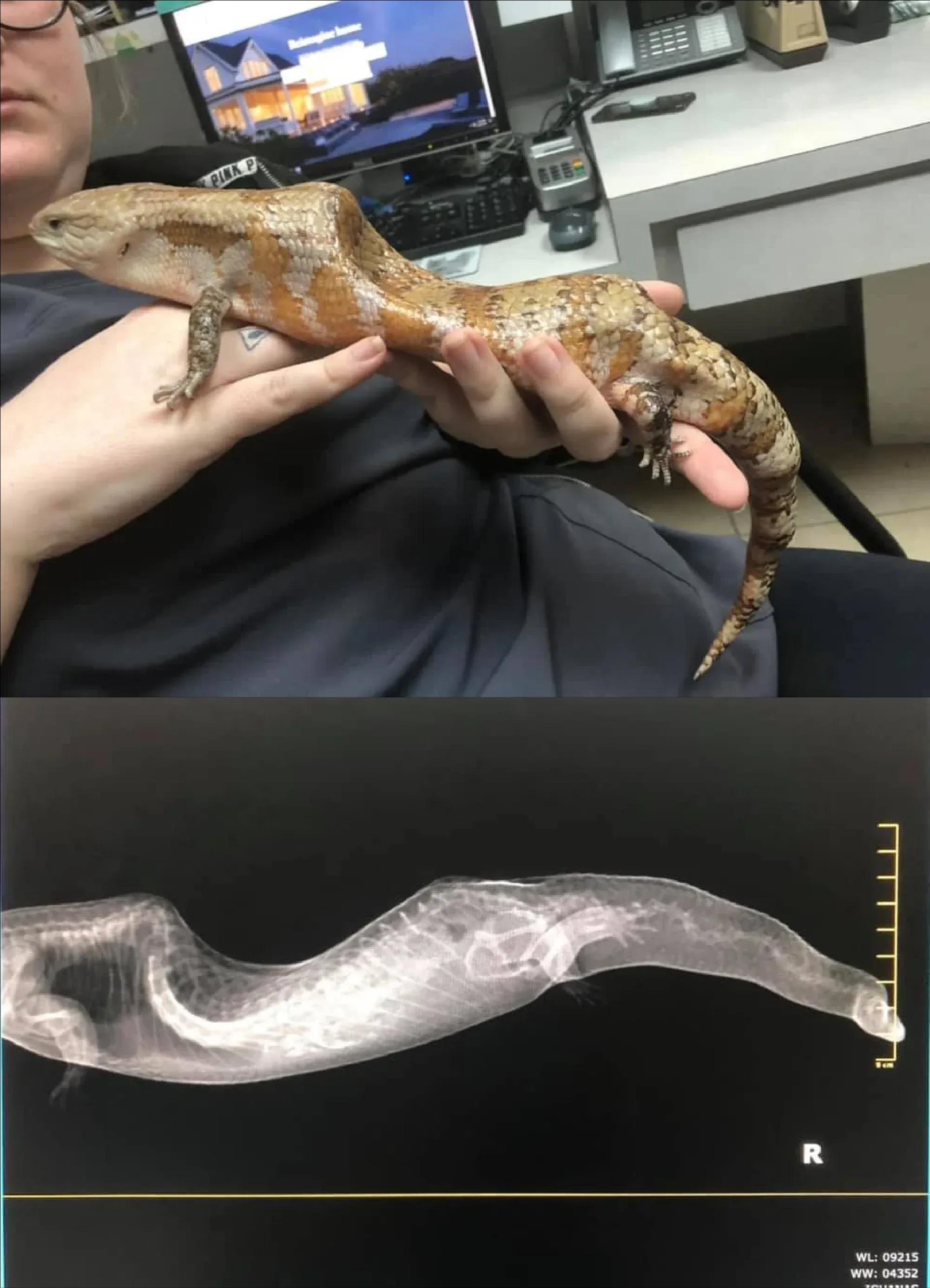 MBD X-Ray Spinal Deformity in BTS